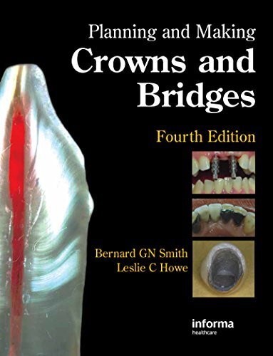 Planning and Making Crowns and Bridges (English Edition)