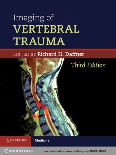 Imaging of Vertebral Trauma (Cambridge Medicine (Hardcover)) (English Edition)