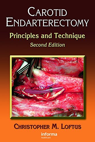 Carotid Endarterectomy: Principles and Technique (English Edition)