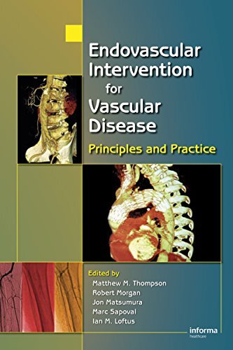 Endovascular Intervention for Vascular Disease: Principles and Practice (English Edition)