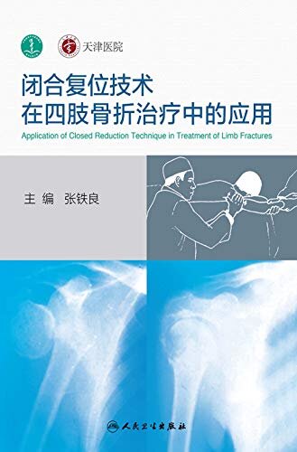 闭合复位技术在四肢骨折治疗中的应用