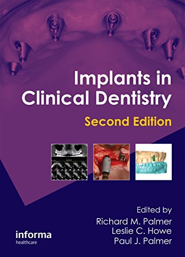 Implants in Clinical Dentistry (English Edition)