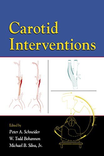 Carotid Interventions (English Edition)